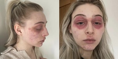 "Как жертва чумы": сильная аллергия на средство для ресниц изуродовала лицо девушки (фото)