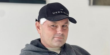 В голову попала пуля: украинские медики восстановили череп военного 3D-пластинами (фото)