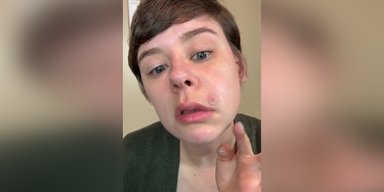 Жінка ледь не втратила життя через прищ на обличчі: лікарі попереджають про "трикутник смерті"