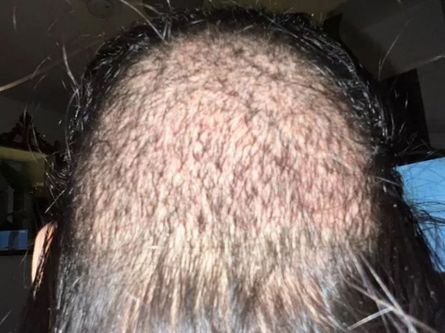 Облысение у женщин, потеря волос, конкурс красоты, внешность, идеал красоты, идеал красоты, трансформация внешности