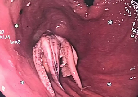 З горла пацієнта дістали восьминога, курйози, екзотичні страви, Сингапур, приколи, операції, лікарі, фото