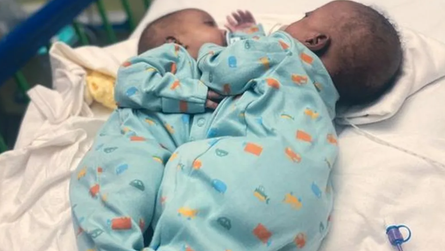 Сіамських близнюків з Великої Британії роз'єднали, операція, хірургія, діагнози