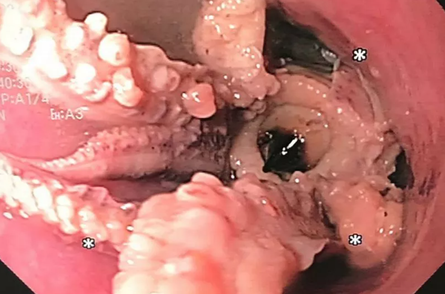 З горла пацієнта дістали восьминога, курйози, екзотичні страви, Сингапур, приколи, операції, лікарі, фото