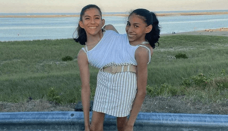 Сіамські близнючки Кармен та Люпіта Андраде, як вони живуть, зовнішність, аномалії, мутації, стосунки, історії цікавих людей, фото