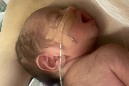 Волосся по всьому тілу в немовлят, зовнішність, дефекти, курйози, пологи, народження дітей, фото, Австралія