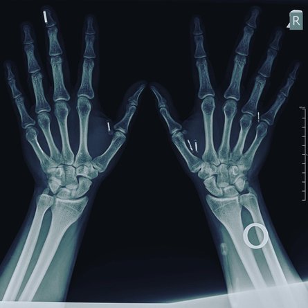 Павло Кльоц, мікрочіп в руці, мікрочіпи на рентгені