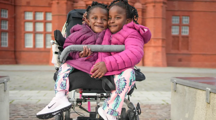 Сіамські близнючки, аномалії, хвороби, діагнози, фото, діти, Велика Британія