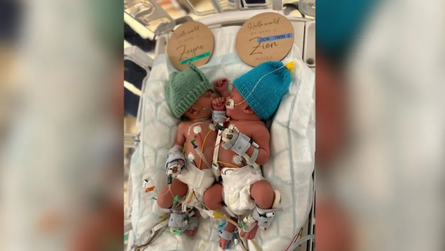 Сіамських близнюків з Великої Британії роз'єднали, операція, хірургія, діагнози