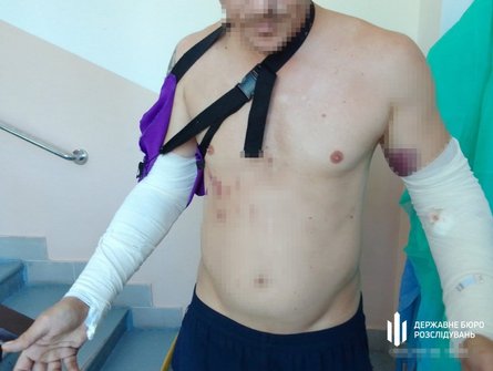 У справі про побиття військового курсант отримав травми обох рук