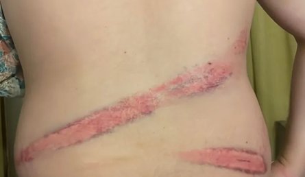 Травмы Иванина, синяки от избиения