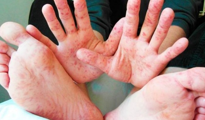 Корью в Украине с начала года заболели более 57 тысяч человек