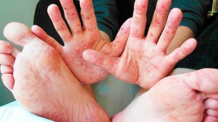 Корью в Украине с начала года заболели более 57 тысяч человек