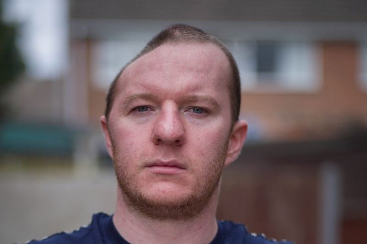 Операция по восстановлению черепа, удалили часть черепа, часть черепа из пластика, новаторская операция, получил сильный удар