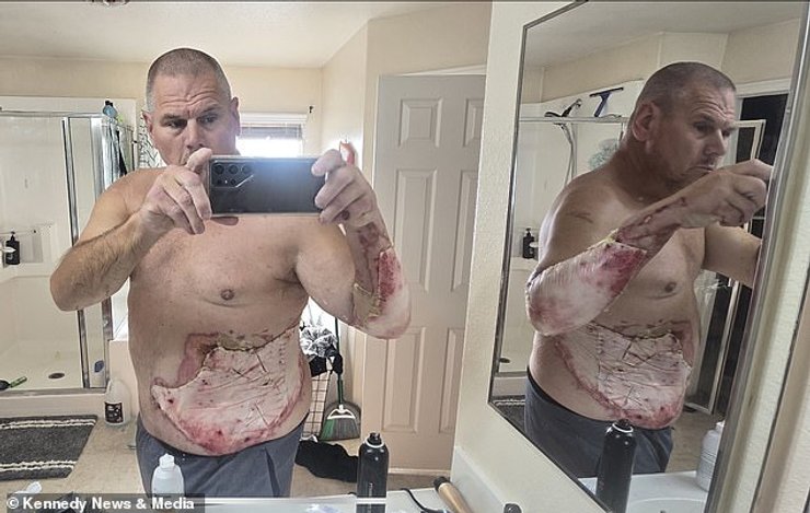 Ожоги третьей степени