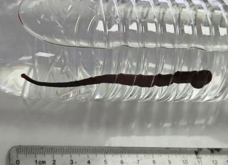 В організмі хлопчика жила жива п'явка завдовжки 12 сантиметрів, як це можливо, неймовірні історії з життя