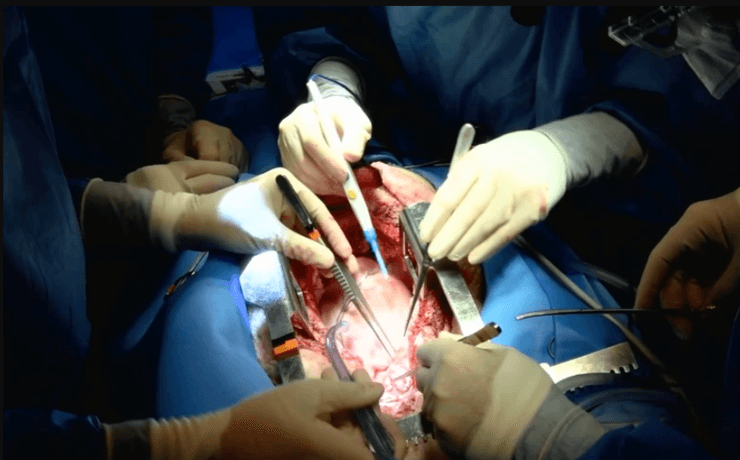 операція, пересадка серця