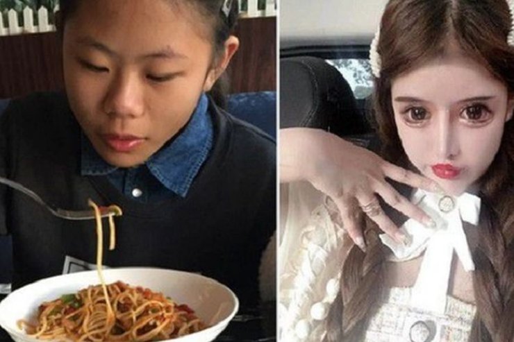 Чжоу Чуна, пластична операція