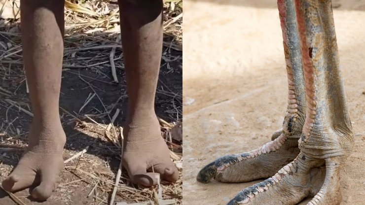 Ноги племени Вадома, ноги, "клешни омара", редкая мутация, нету пальцев, страусиные ноги, люди-страусы, эктродактилия, загадка племени