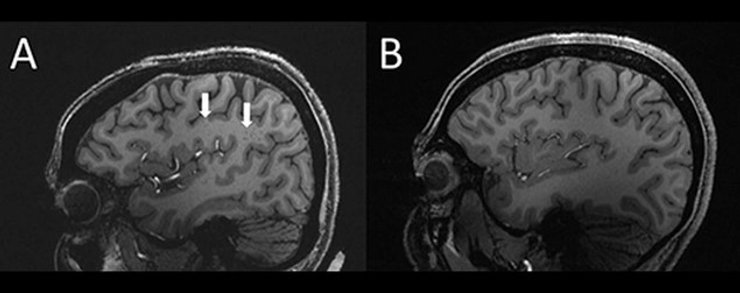 мозг, головной мозг, человек