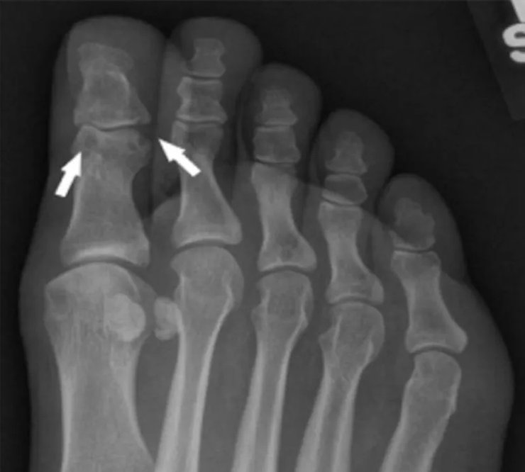 рентген стопы