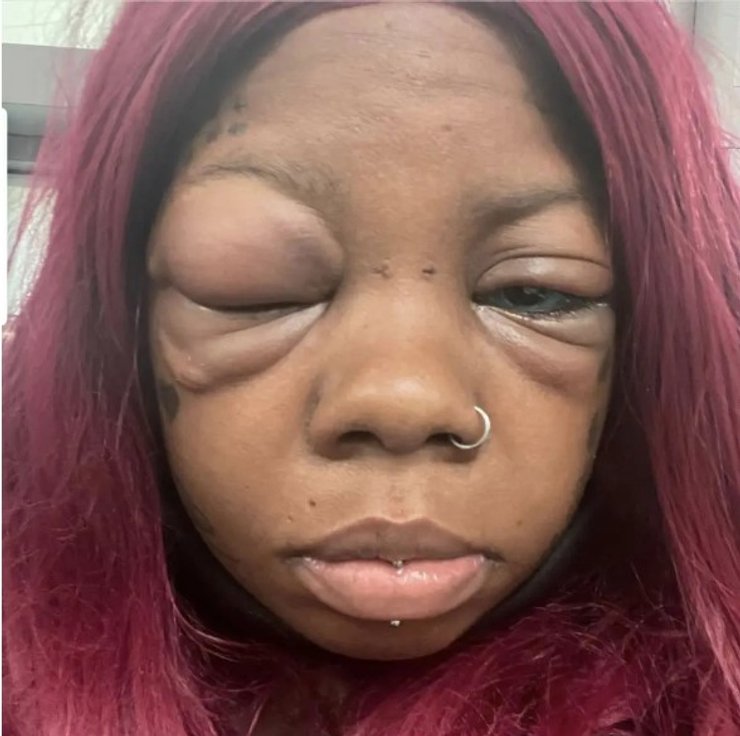 женщина ослепла от тату на глазах