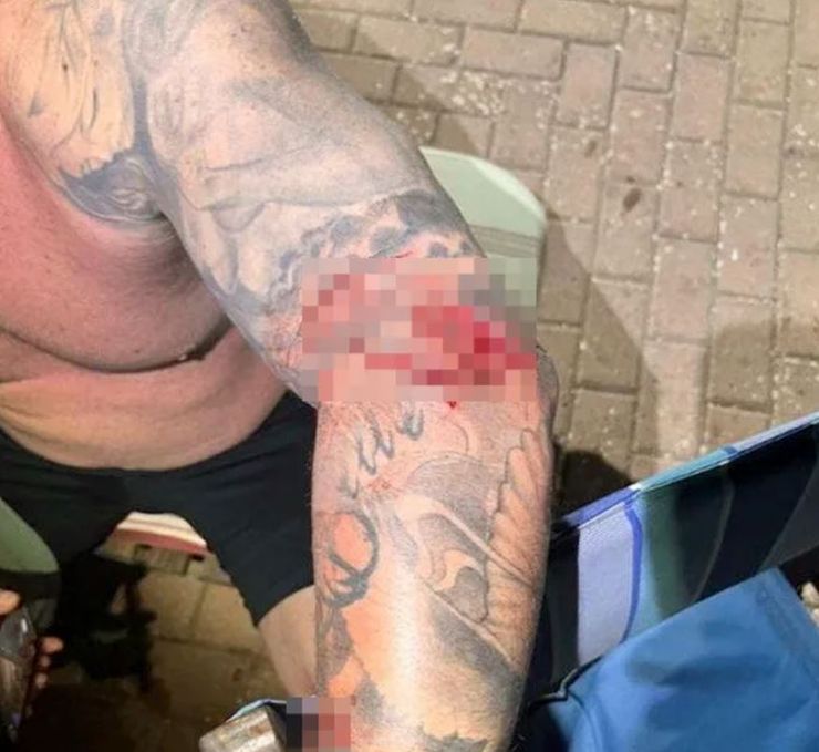 Мужчина показал последствия нападения 140-килограммовой акулы, хищница сделала вид, что мертва, и атаковала его