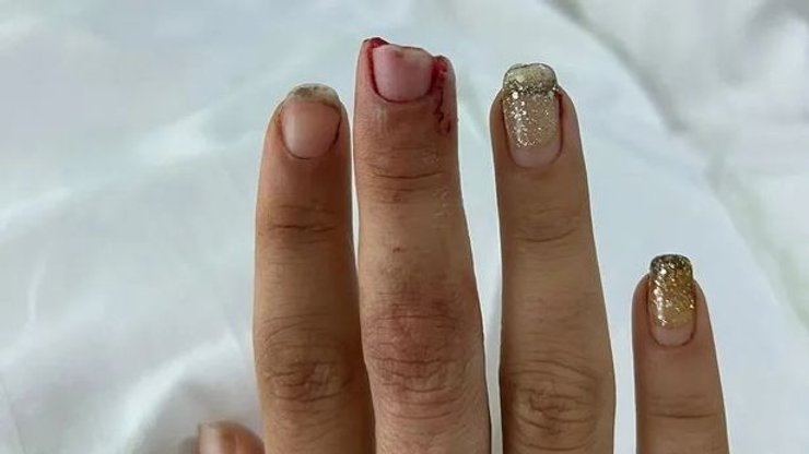 Палець без відкушеної частини