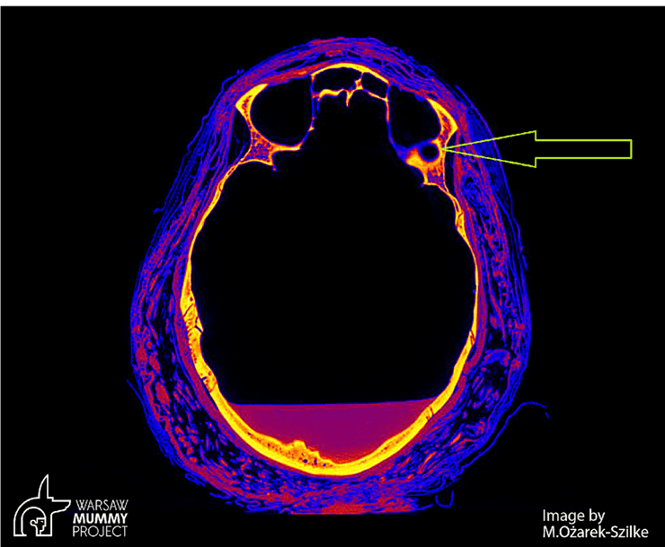 череп, зміна в черепі, пухлина, фото