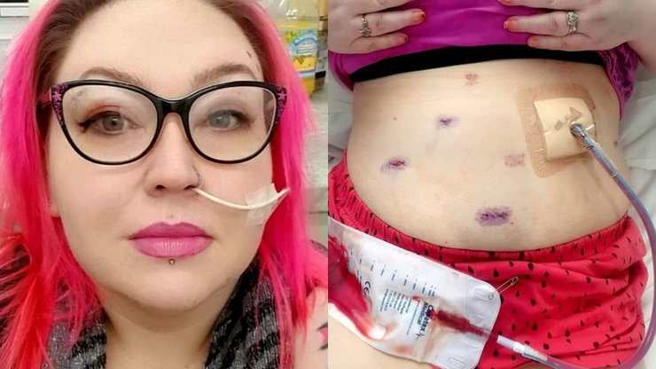 Женщина, девушка, операция, больница, похудение, желудок, катетор