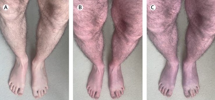 ноги, коронавірус