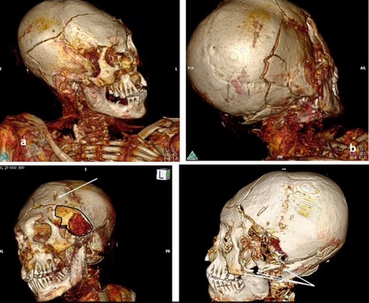 череп, томография