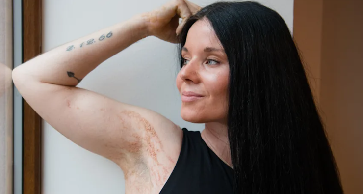 Мария Жампачева, расстройство, странный диагноз, генетическое заболевание, проблемы с кожей, фото, Чехия