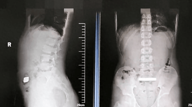 Золотой слиток нашли в желудке 11-летнего мальчика, как это могло произойти, странные истории, инциденты, операции