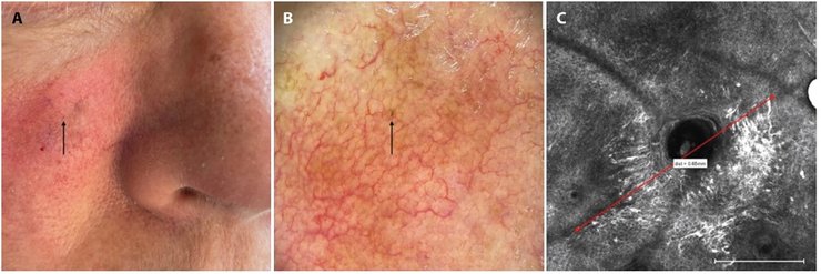рак кожи, меланома, самый маленький в мире рак кожи, кожное новообразование