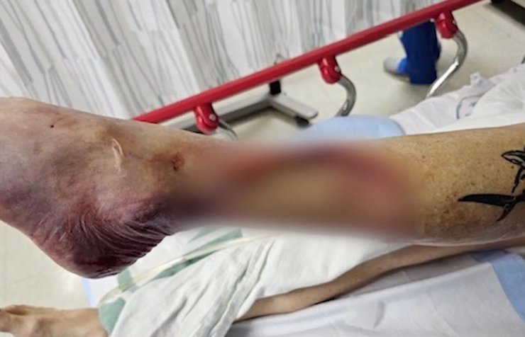 Нога Гайді Ернст, фото