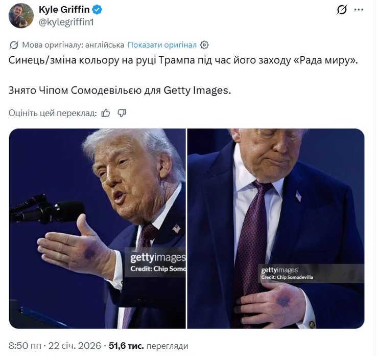 фото руки з синяцями у Дональда Трампа січень 2026