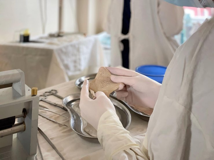 пересадка кожи, трансплантация, операция, врачи, медики