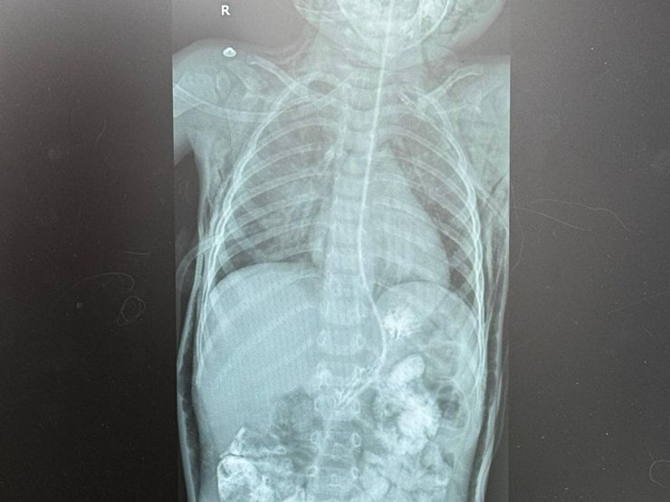 У мальчика произошел разрыв трахеи