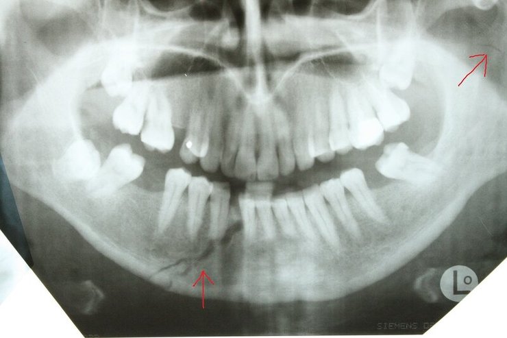 Зламана в результаті ДТП щелепа Адама Кадирова