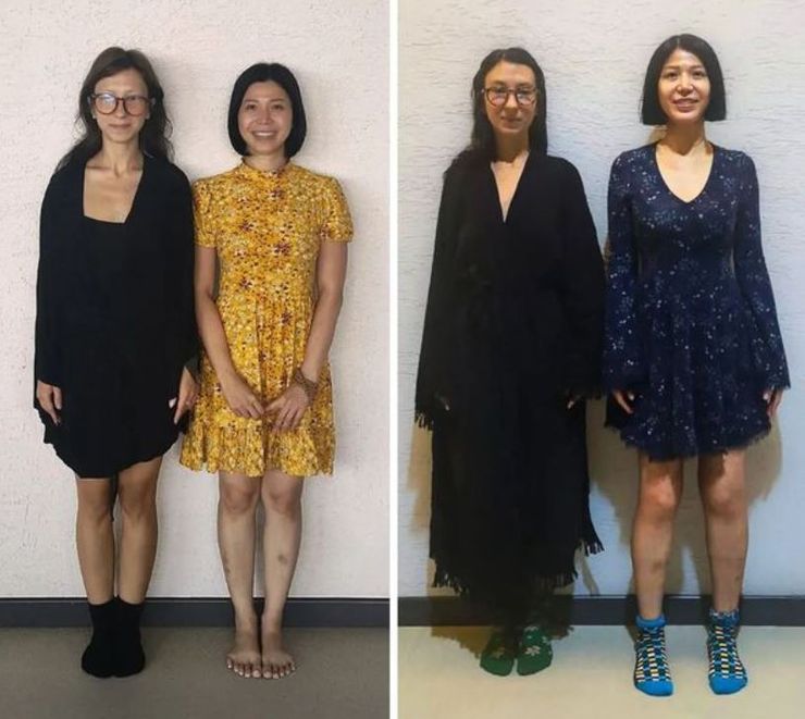 Як збільшити свій зріст, шляхи збільшення росту, операція, хірургічним шляхом стати вищим