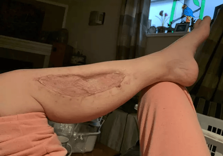 Нога, рана, ноги, мышцы, операция