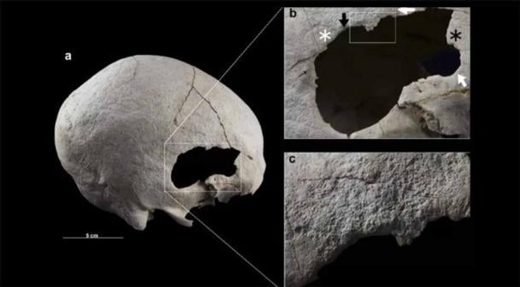 Стародавня хірургія мозку, трепанація, жінка мідного віку, археологічне відкриття, виживання після трепанації, доісторичні медичні практики, хірургія скроневої ділянки, стародавні хірургічні техніки