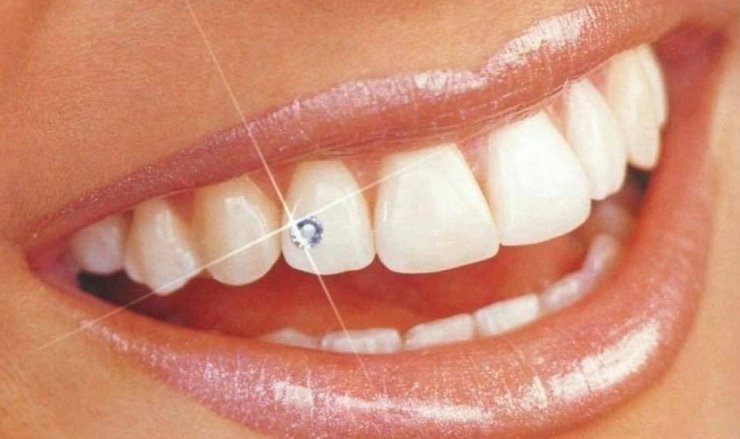 украшение для зубов