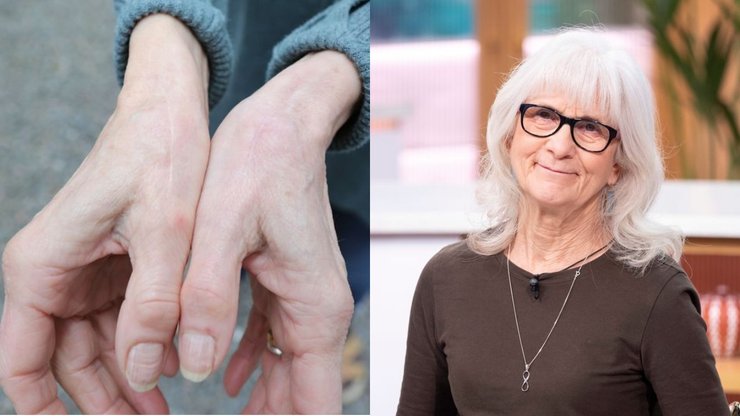 Женщина не чувствует боли, женщина, британка, редкая мутация, операция, руки, ученные, регенерация