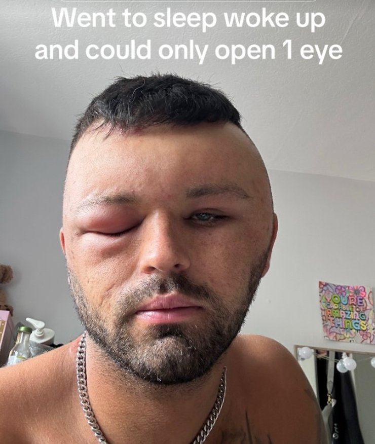 Курйоз в Британії, Ryan Briggs, Раян Брігс, лікування, алергія, набряк обличчя