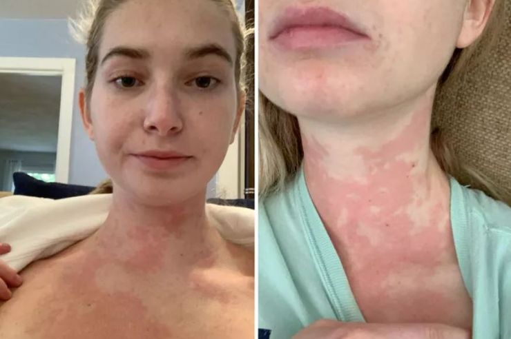 Кэролайн Крей, странные диагнозы, болезни, организм, расстройства, интересные истории, питание, рацион, США