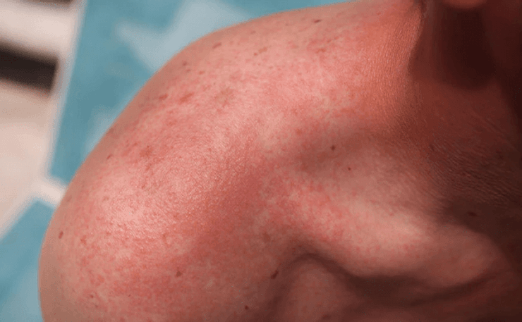 солнечный ожог, мальчик, ключицы, фото