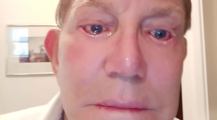 4 года не мог закрыть глаза, проблемы с глазами, неудачная операция, пережил несколько операций, пластика лица, не мог спать, ринопластика