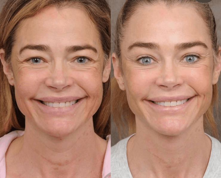 Деніз Річардс зробила підтяжку обличчя