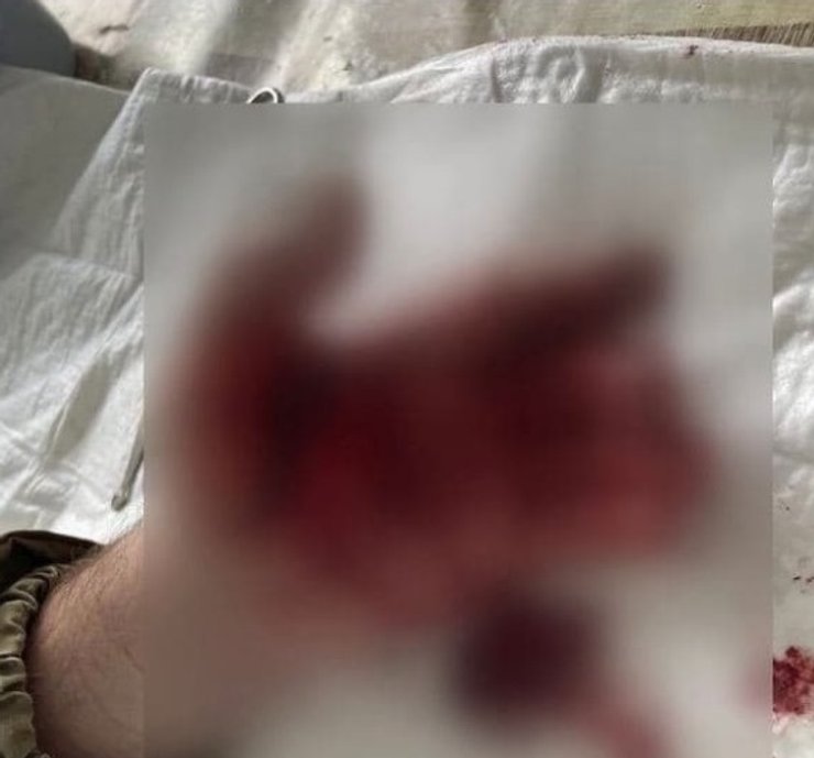 Поранений боєць, поранений, вибух гранати